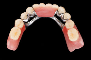 A closeup of a lower dental skeletal prosthesis with porcelain crowns and dolder - isolated on white.