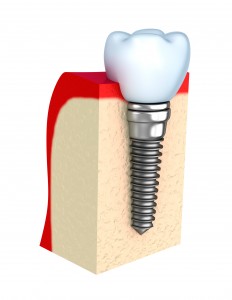 dental implants closeup